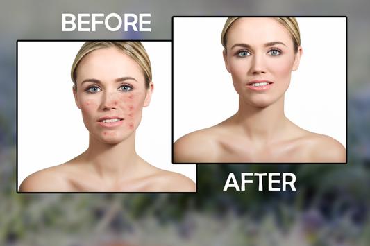 Pimple Remover Acne Remover